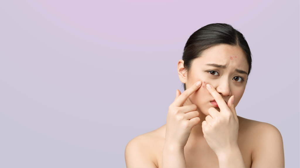 Acne treatment